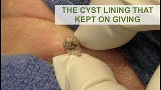 The Cyst Lining that Kept on Giving | Dr. Derm