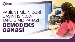 DEMODEKS GƏNƏSİ - Bonum Medical Laboratoriyası