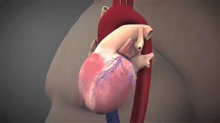 Heart Valve Replacement