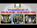 How to read CT scan abdomen - Colon, appendix