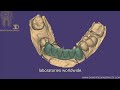 exocad 6 units bridge designs for a dental laboratory