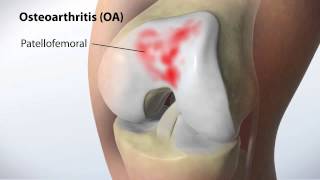 Knee arthritis & Knee replacement MAKOplasty procedure Orthopedic Center of Il. Osteoarthritis knee