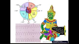 อ่านแกนของหัวใจ EKG AXIS