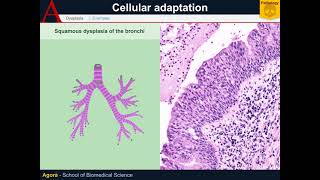 Cellular Pathology - Dysplasia