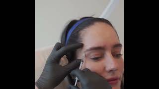 Facial Rejuvenation with Botox | 8 West Clinic - Vancouver, BC