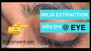 MILIA EXTRACTION | सफ़ेद फुंसी वाला दाना आँख के पास | इलाज FULL VIDEO by DERMATOLOGIST in HINDI 👁🖕