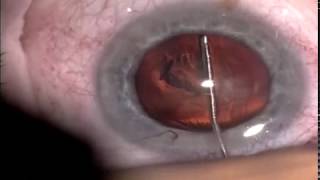 Cataract Surgery PEX