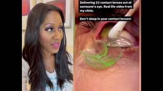 Woman Has 23 Contact Lenses Removed from Her Eye! A Doctor Discusses this Viral Video