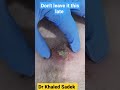 massive cyst infection cystremoval dr khaled sadek