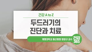 두드러기의 진단과 치료 [TBC클리닉건강365]