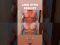 GYNECOMASTIA SURGERY RESULTS #beforeandafter #gynosurgeon #antiaging #transformation #aesthetic