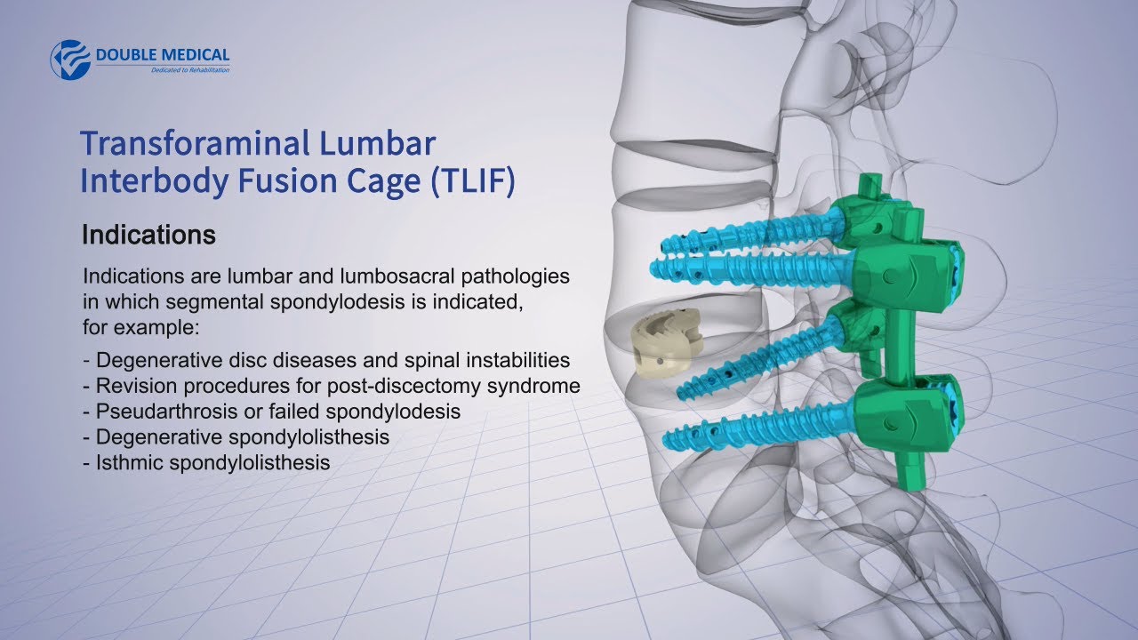 What Is Lumbar Spine Fusion Surgery At Brant Roberts Blog