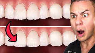 Why Small Tooth Chips Are EXTREMELY Hard To Fix! 🦷😮