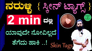 Naruli Removal in Kannada | Naruli Treatment in Kannada | Naroli Mane Maddu in Kannada | Skin Tags