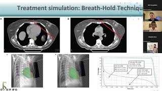 Breast Treatment Planning & Simulation