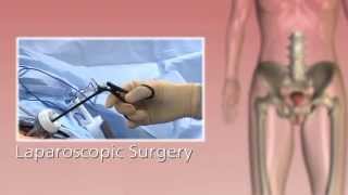 da Vinci - Hysterectomy for Benign Conditions