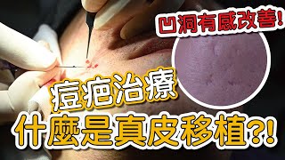 真皮移植手術非常適合填補凹陷型痘疤及萎縮型的痘疤！#shorts