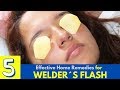 Top 5 Home Remedies To Treat Welder's Flash - Eye Pain Home Remedies - Arc Eye Home Remedies