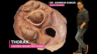 THORAX (Cadaveric images discussion)