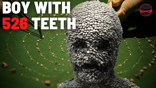 The Boy Who Had 526 teeth In His Mouth