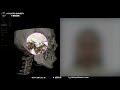 sub 광대수술 후 입 벌리거나 씹으면 아프고 소리가 나요 비대면상담 124 pain and noise after cheekbone surgery