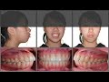 Soft tissue changes following orthodontic treatment in adult patients of Taiwan