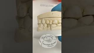 Porcelain Bonded Crown 🦷 | Restore Your Smile with Strength and Beauty!