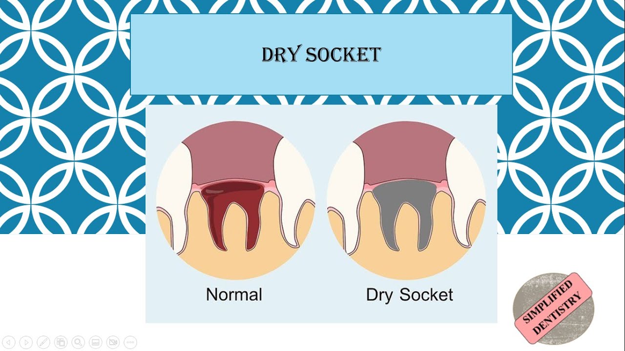 Normal Socket Vs Dry Socket Influence Of Immediate Post Extraction