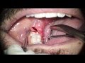 Extraction Without Forceps (E.W.F.) - Dr. Fabio Cozzolino | Zerodonto