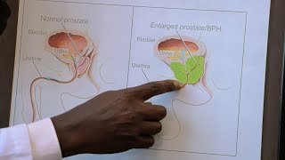 BUNO BWE BUZIBU OMUSAJJA BWAYOLEKEDE BWALWA N'OBULWADDE BWA PROSTATE BPH? - COMPLICATIONS.