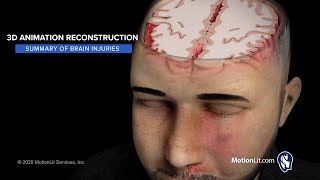 Head Trauma Animation Depicts Scope Of Brain Injuries Ensued After Bar Fight