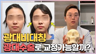 얼굴비대칭 주목!! 과연 광대 비대칭은 광대수술로 교정이 가능할까?