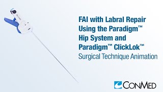 FAI with Labral Repair Using the Paradigm™ System and Paradigm™ ClickLok™ - CONMED Technique