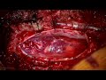 Clip Occlusion of a Thoracic Spinal Cord Perimedullary Fistula (Intradural Ventral AV Fistula)