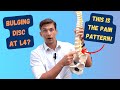 L4 Bulging Disc Pain Pattern Explained!