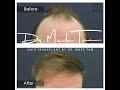 hair transplant for frontal area hairloss hair transplant by dr mark tam harley street london