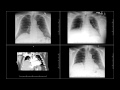 Chest tube probably injured phrenic nerve and cause right diaphramatic paralysi