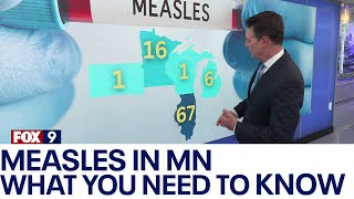 Measles in MN: Experts urge vaccinations