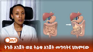 የትንሹ አንጀት ወደ ትልቁ አንጀት መግባትና ህክምናው