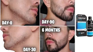 beard growth | Mintop minoxidil review |minoxidil beard growth 6 months | derma roller for beard