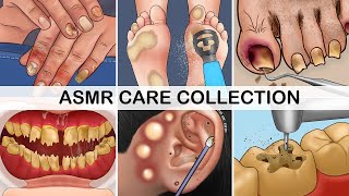 ASMR eye cleaning |  ear wax | feet tickling | ingrown nail | pimple popping