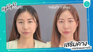 ปัญหาคางสั้นคางถอยจะหมดไป ด้วยการศัลยกรรมคาง โดยคุณหมอปอนด์