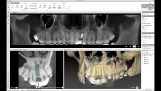 Implantáció navigációs sablonnal: NobelGuide - single unit case in maxilla