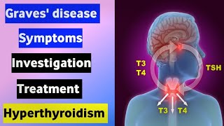 Graves disease symptoms, investigation in hindi//Hyperthyroidism