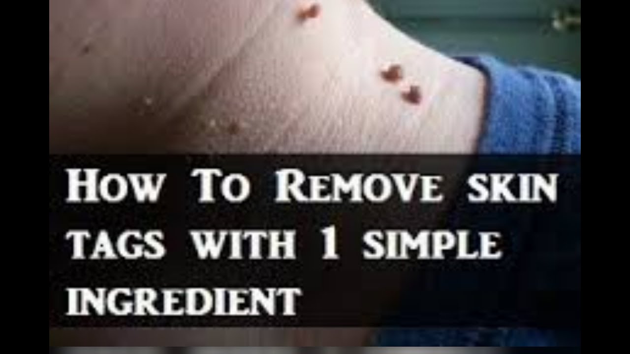 How To Remove Skin Tag Naturally Get Rid Of Skin Tags Fast Youtube