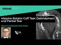 Massive Rotator Cuff Tear: Debridement and Partial Tear - Michael T. Freehill, MD, FAOA, FAAOS