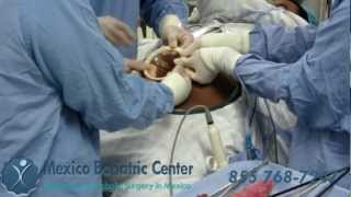 First Single Incision Gastric Sleeve Surgery @ MexicoBariatricCenter