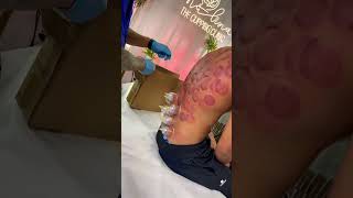 Fire cupping #cuppingtherapy #shorts #skincareroutine