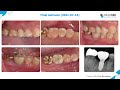 dr. yongseok cho sewoung kim 37 late 46 immediate implant surgery and prosthesis