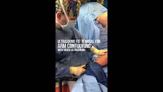 Ultrasound Fat Removal | Arm Contouring | Liposuction | Jason Emer MD